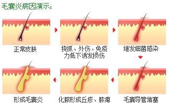 在昆明毛囊炎如何预防-昆明太医堂皮肤病医院